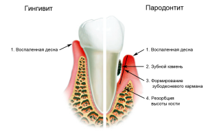 gipertroficheskij-gingivit3