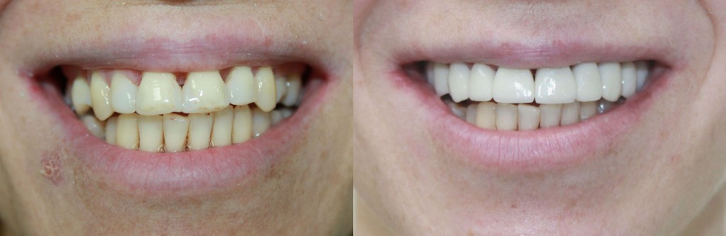 IPS e.max Press upper jaw, lower jaw-teeth whitening